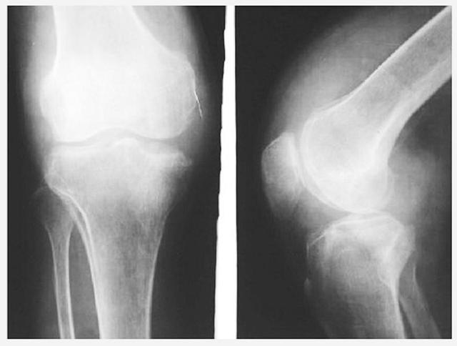 膝盖积水真实图片 x光图片