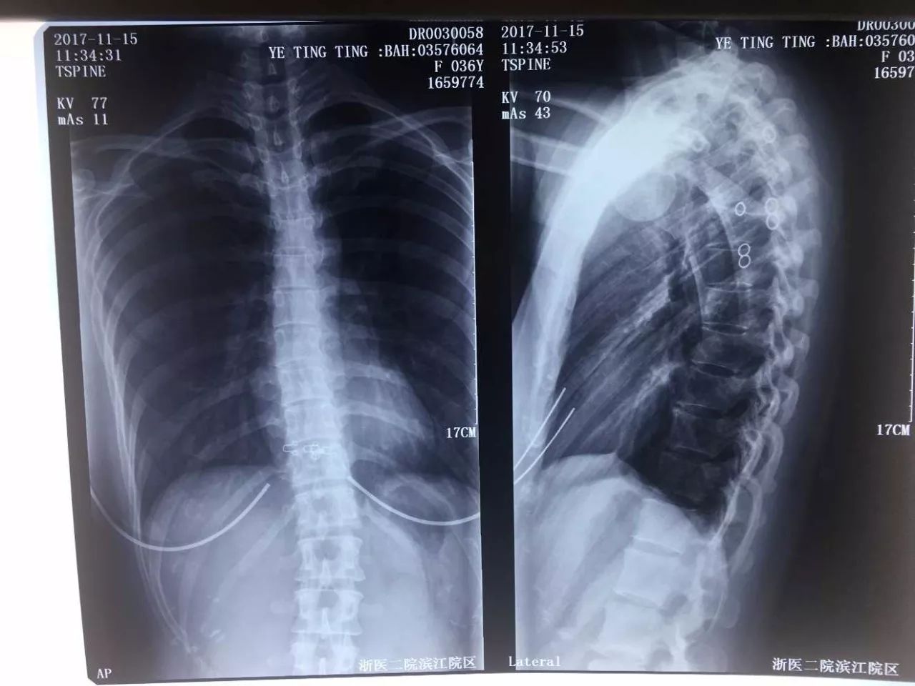 dj案例分享一例倒立引發的背疼