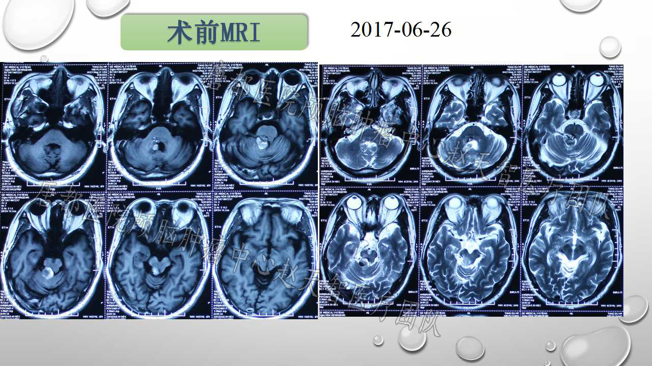 魏先生6月26日入院進一步完善影像學檢查,頭顱核磁共振(mri),ct,dti