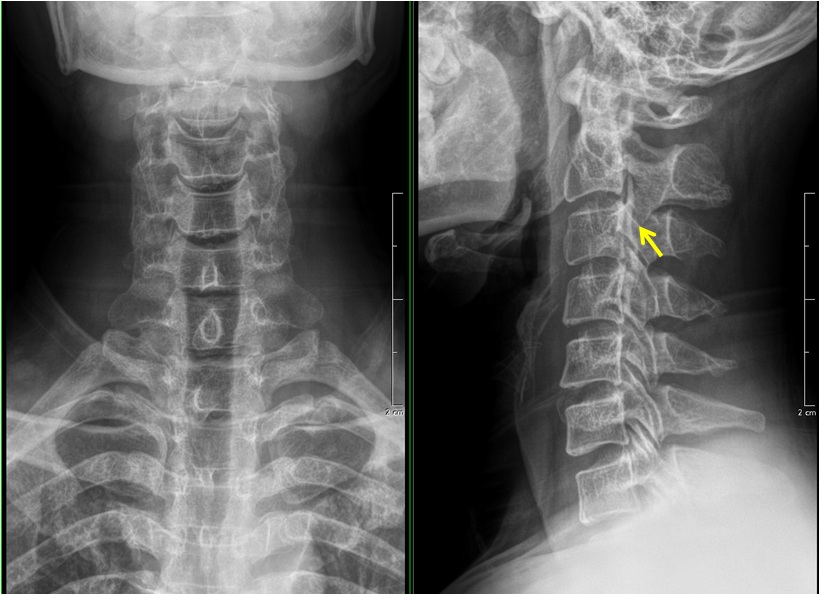 不正常的颈椎x光片图图片