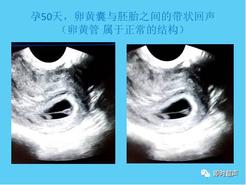 9-16周的正常表現)4,羊膜帶綜合徵:與胎兒粘連造成胎兒畸形子宮先天