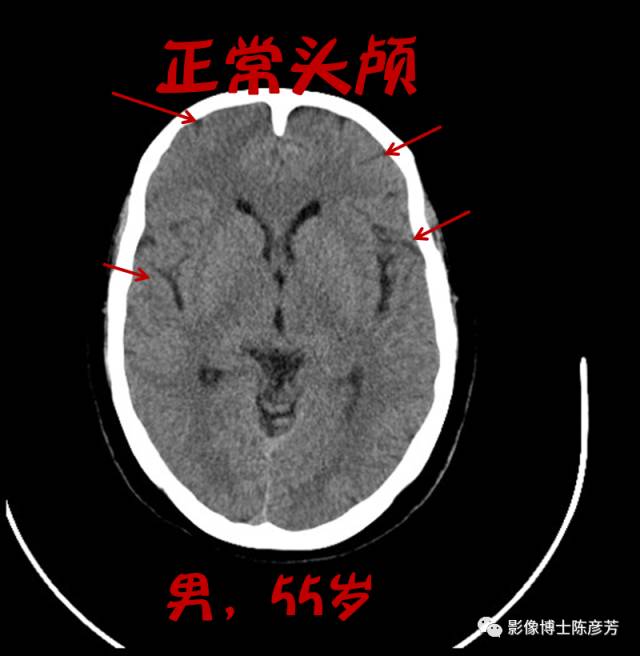 脑萎缩正常图片