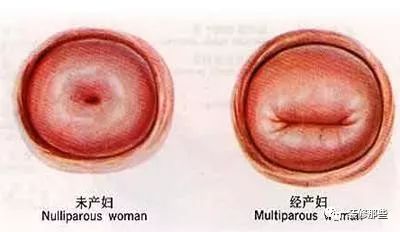 生完孩子宫颈口图片图片