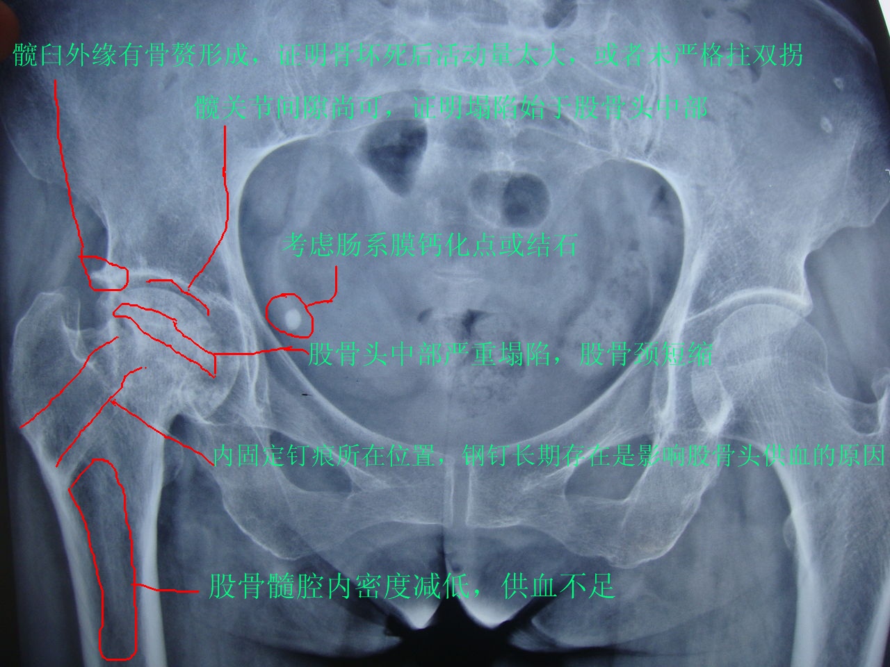 股骨头早期图片