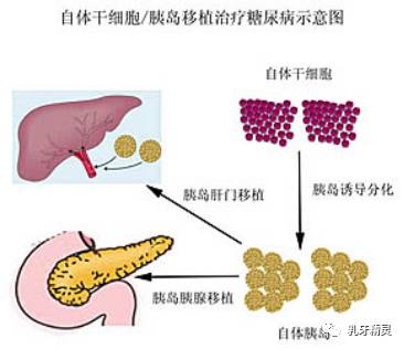 福音丨干细胞疗法治疗糖尿病日渐成熟