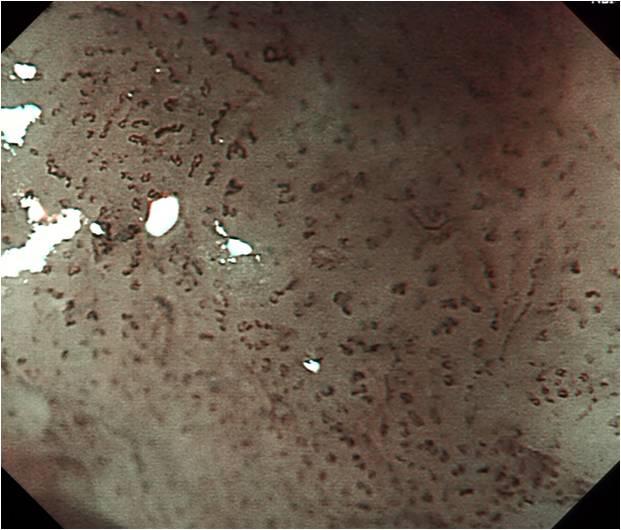 内镜下表现图2:nbi观察茶色改变明显