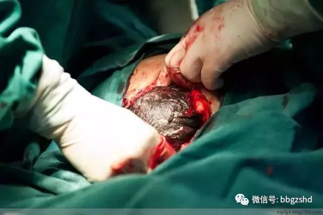 孕妈宝典100张剖腹产过程照片看完才知道生孩子有多不容易