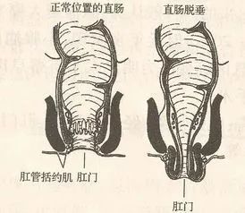 大肠头脱肛相关图片图片