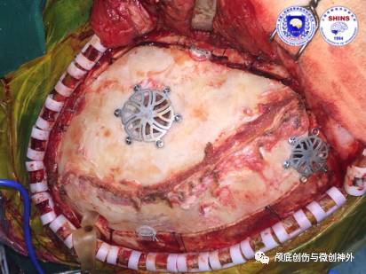 左侧额颞顶大骨瓣硬膜下血肿清除术一例丨颅脑创伤