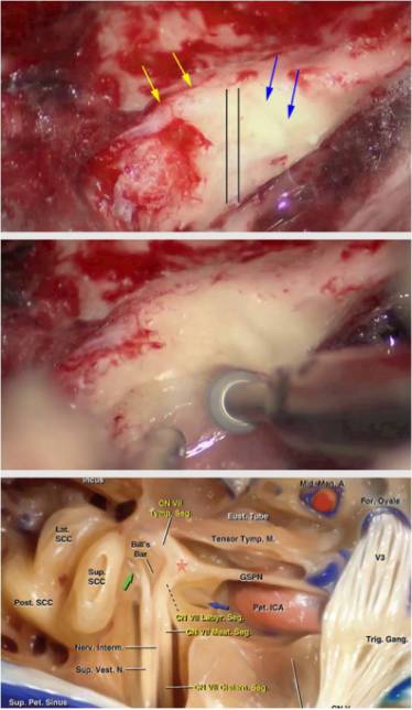 中顱底入路切除聽神經瘤手術策略與技巧theneurosurgicalatlas全文