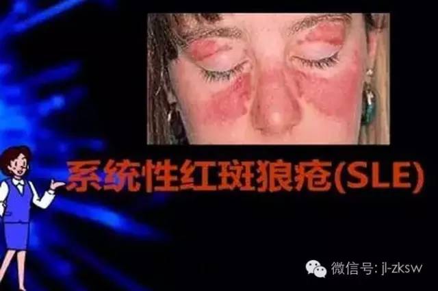 吉林中科:幹細胞治療系統性紅斑狼瘡新突破