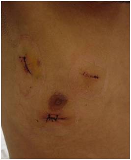 起搏器手术后疤痕图片图片