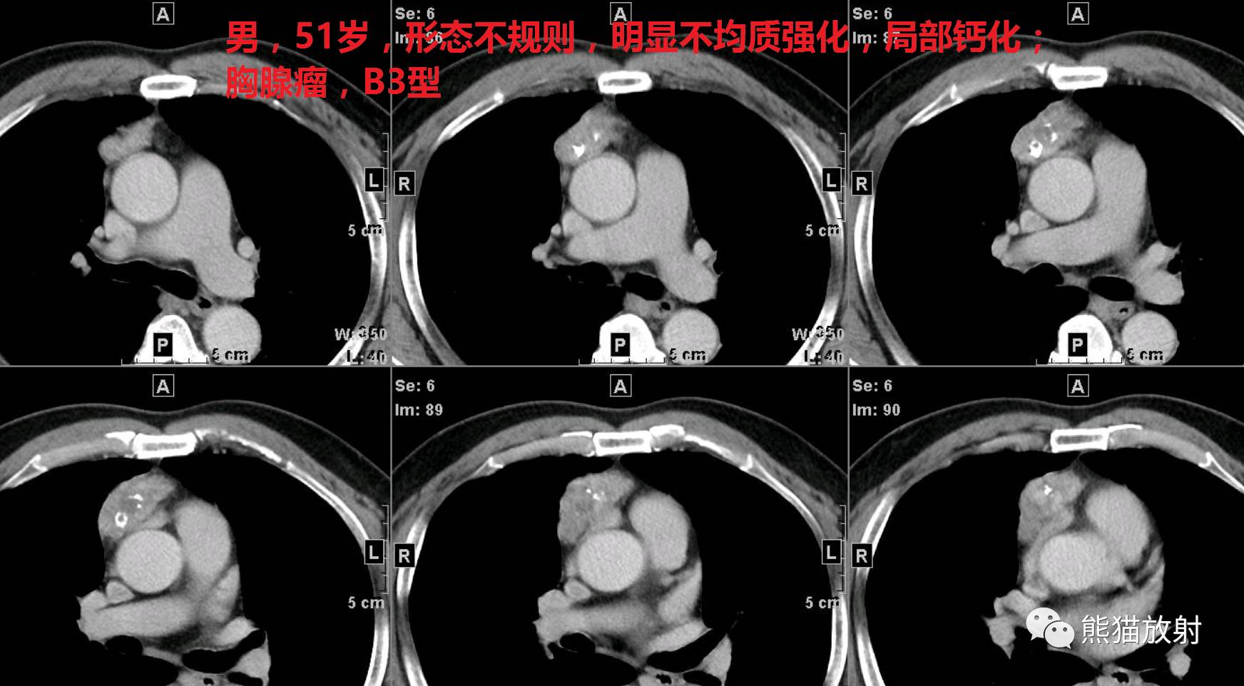 胸腺上皮性腫瘤最新組織學分型臨床分期影像表現