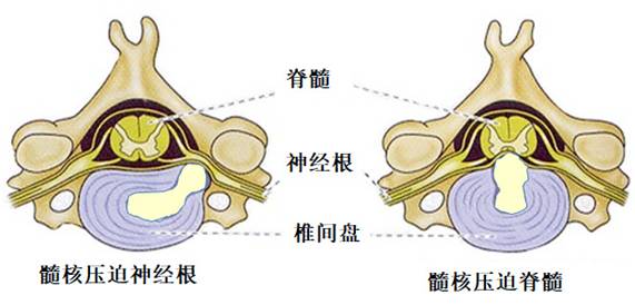 【汪博士医学讲堂】颈椎病可以防治