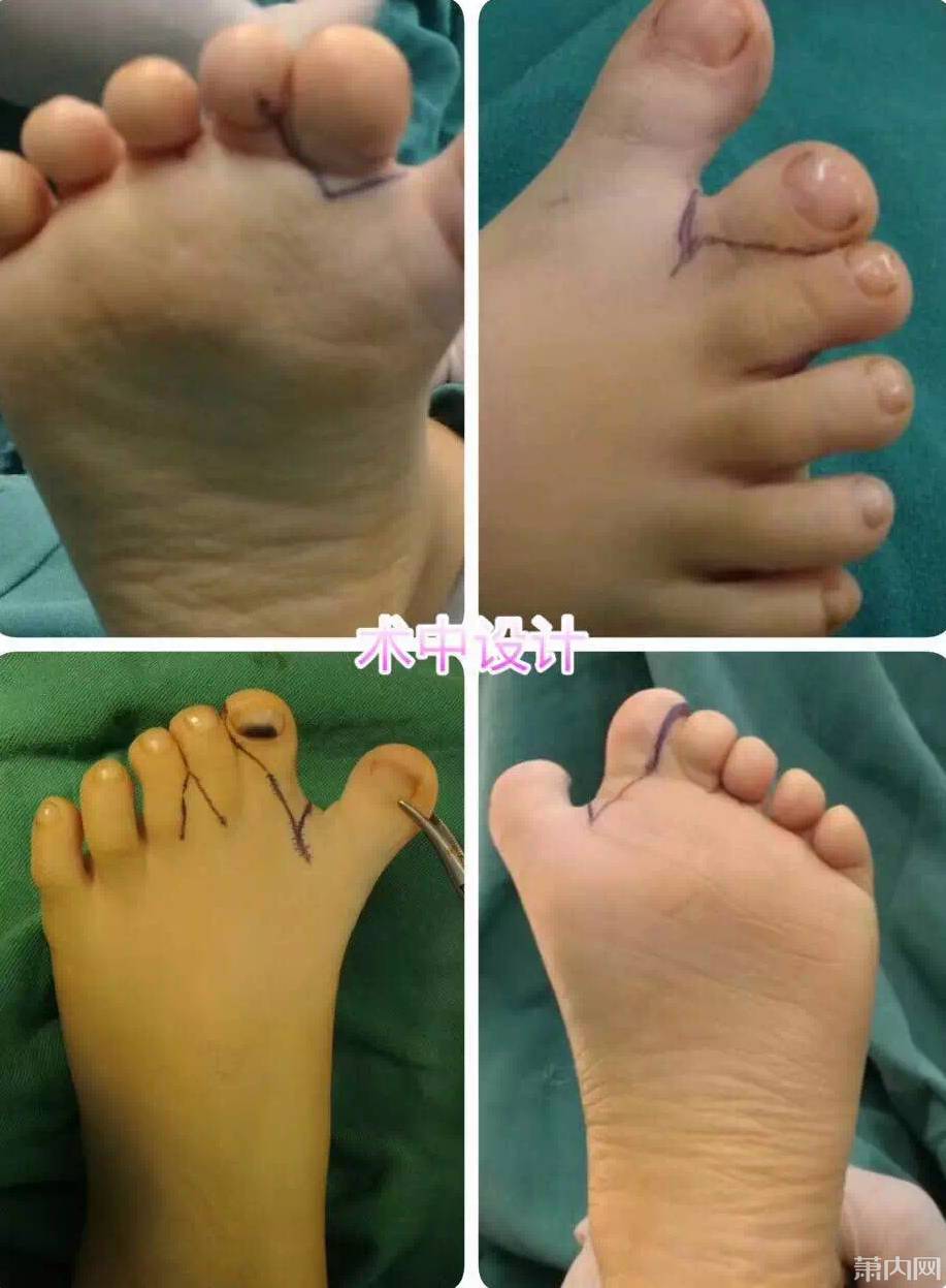 萧山3岁男孩先天性手指并连有12个脚趾经两组手术成功矫正