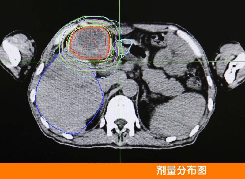 射波刀放射外科,為肝癌患者帶來希望!