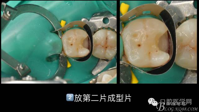 银汞成型片图片