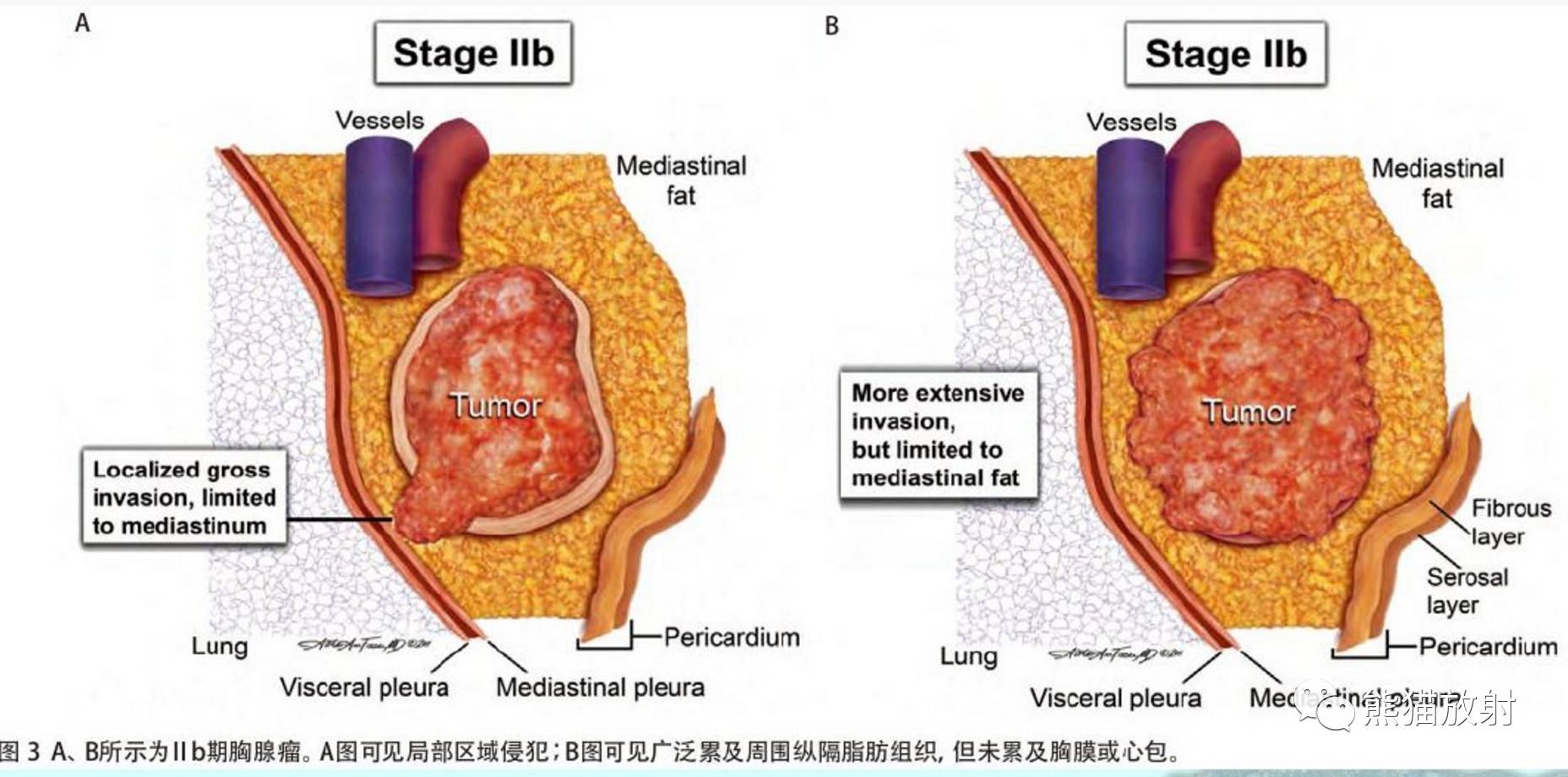 胸腺上皮性腫瘤最新組織學分型臨床分期影像表現