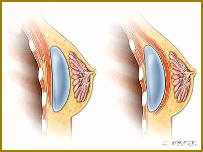 丰胸手术图解图片