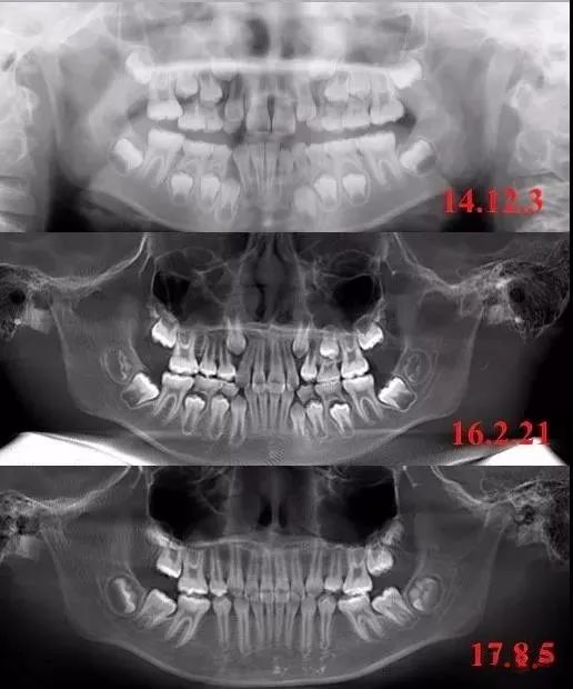 换牙期x光图片