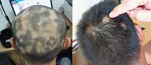 2岁半男孩上补习班后疯狂掉发,专家:精神因素会诱发斑秃