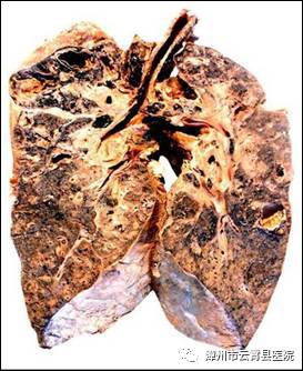 正常肺与肺结核图片图片