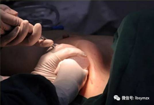 假体隆胸手术全过程图片