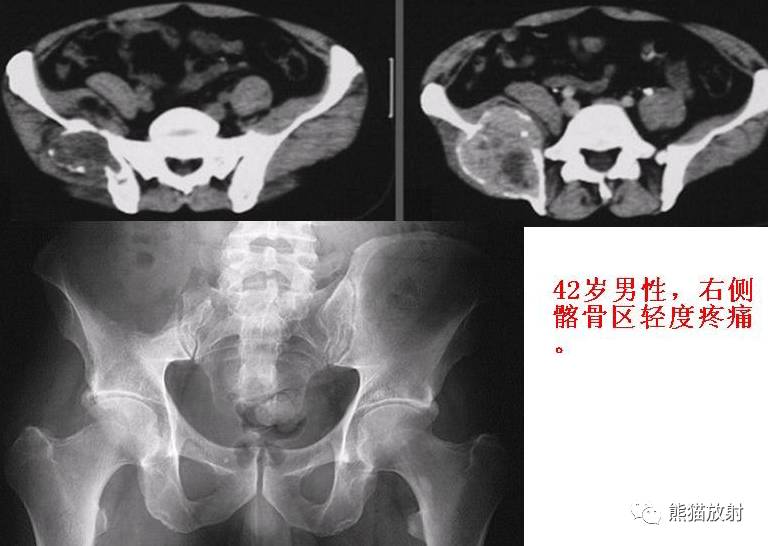 男,15歲.(脛骨上端)軟骨母細胞瘤.女,55歲.(脛骨上段)轉移性腺癌.