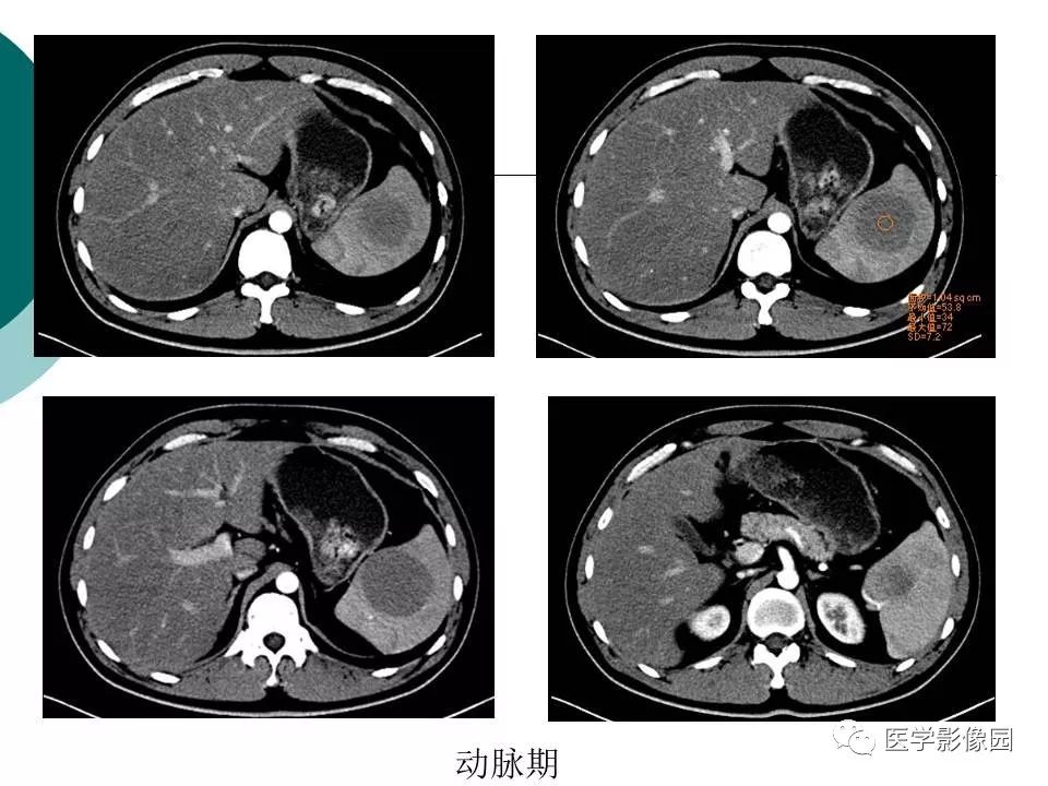 脾脏实性结节等你分析丨读片专栏627期