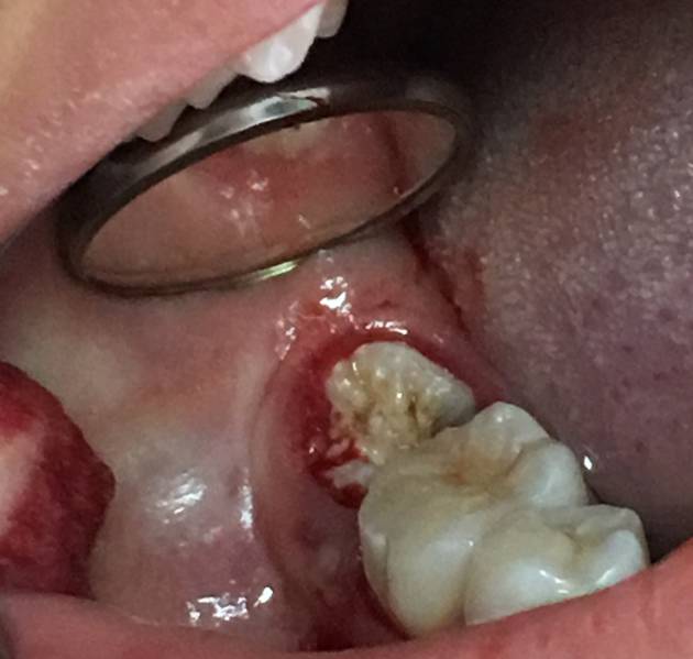 多见于上颌埋伏尖牙压迫中切牙牙根吸收,下颌埋伏智齿导致第二磨牙