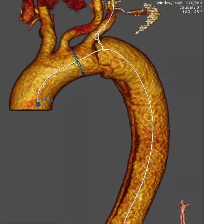 主动脉夹层三维重建图图片