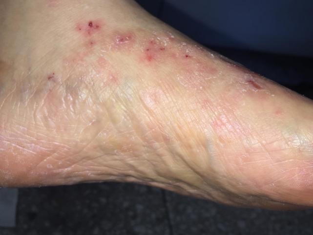 脚气不当回事儿出现细菌感染导致丹毒就麻烦大了