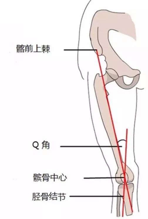 q角是指胫骨结节和髌骨中心的连线与髌骨中心和髋骨髂前上棘之间连线