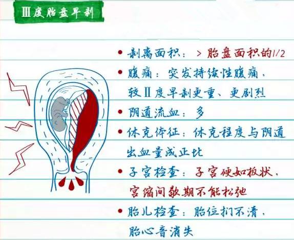 解析:產科醫生最害怕的「胎盤早剝」