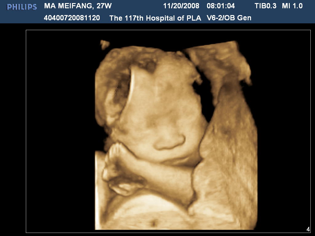 表面特征,空间位置关系,提供胎儿在宫内的立体图像,因此还可诊断胎儿