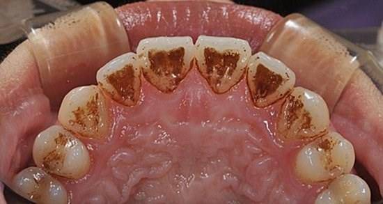 日常牙垢清洗防止牙石生成5大方法任你選擇