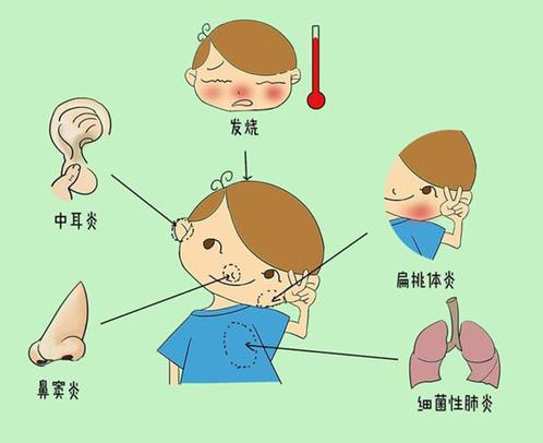 5℃,持續增長1~2天不退或有高熱驚厥者;3,急性化膿性扁桃體炎;2,鼻竇