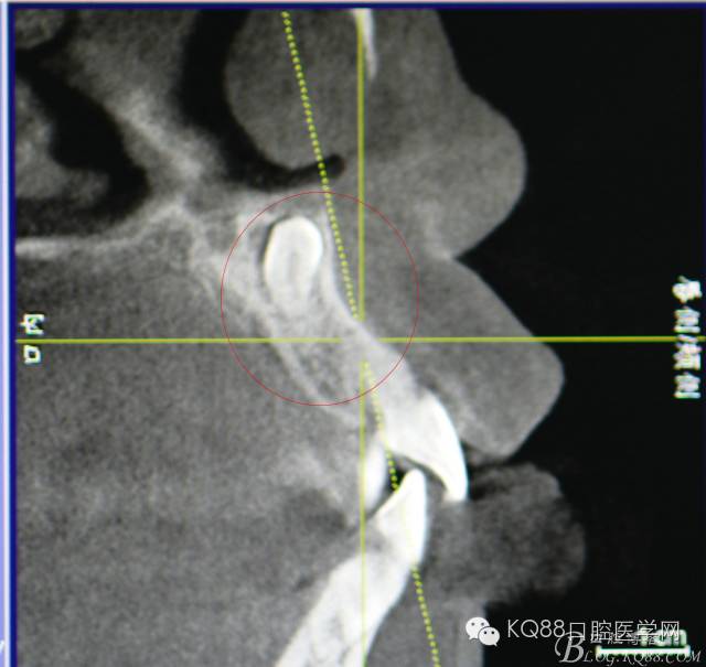 cbct全景片重建檢查:11根尖區上方有一倒置多生牙手術過程:患者,女,13