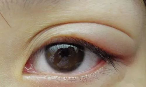 梅毒瞳孔异常图片图片