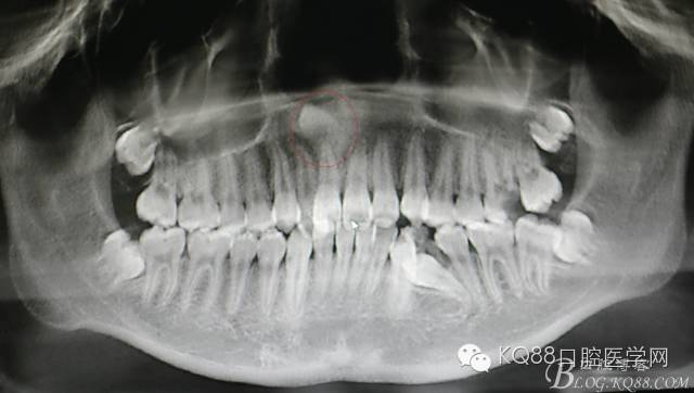 cbct全景片重建檢查:11根尖區上方有一倒置多生牙手術過程:患者,女,13