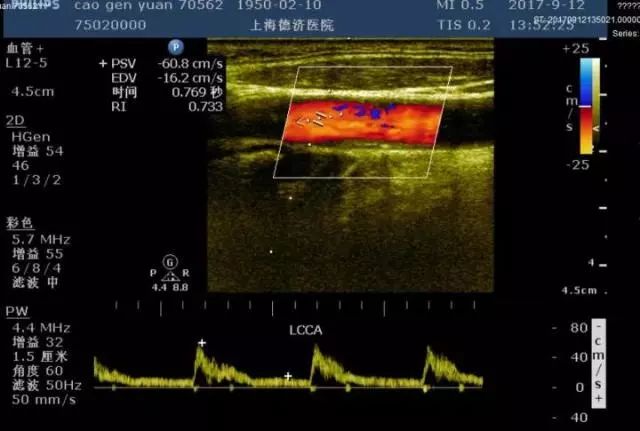 頸動脈彩超提示了左側椎動脈血流異常(考慮左側鎖骨下動脈盜血綜合徵)