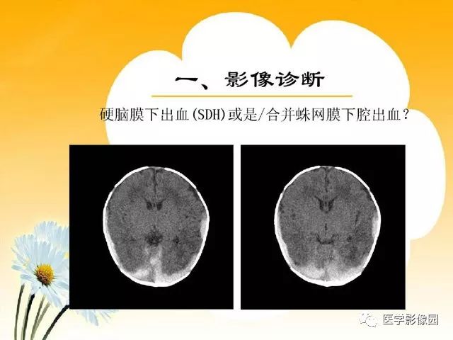 新生儿颅内出血对比影像学检查知多少丨影像天地