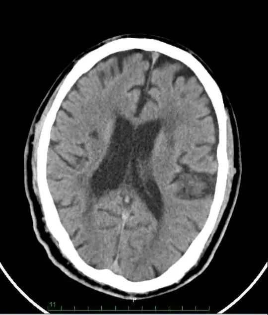 头颅ct提示1,右侧半卵圆中心,双侧放射冠