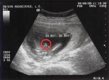 孕囊形状看性别图片