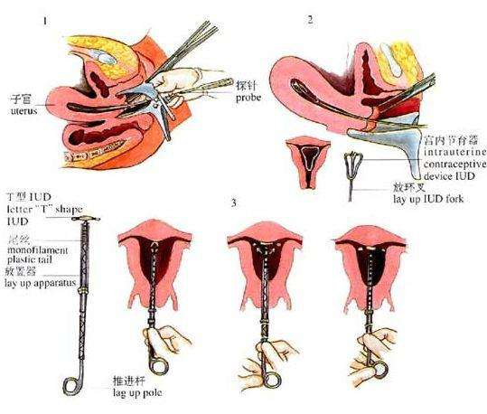 人流清宫手术过程图片图片