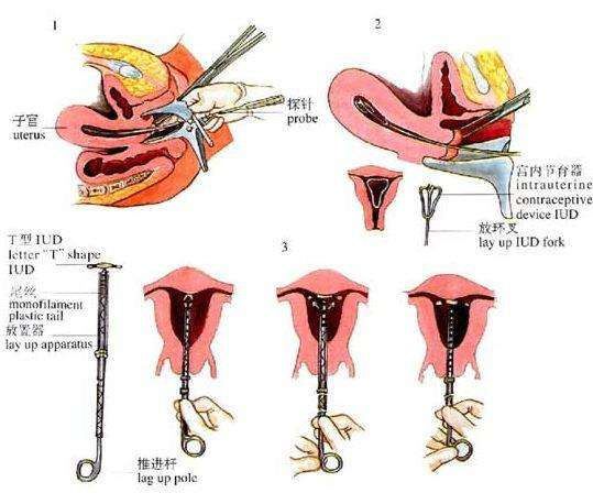 上环相当于月月刮宫流产术上环对女人的伤害有多大看图就知道了