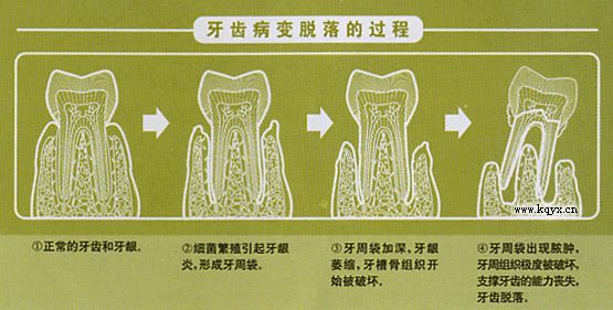 牙周炎自愈最佳方法图片