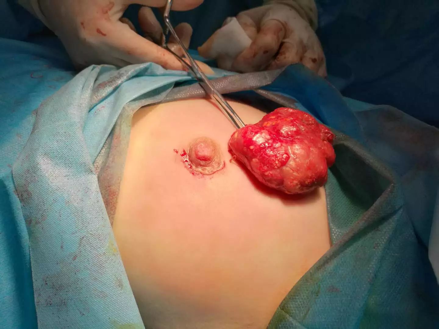 乳腺导管瘤图片图片