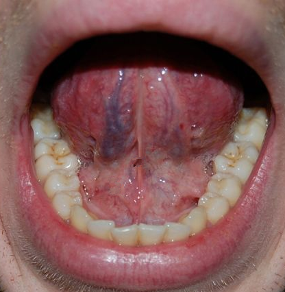 舌头下边血管发紫又粗图片