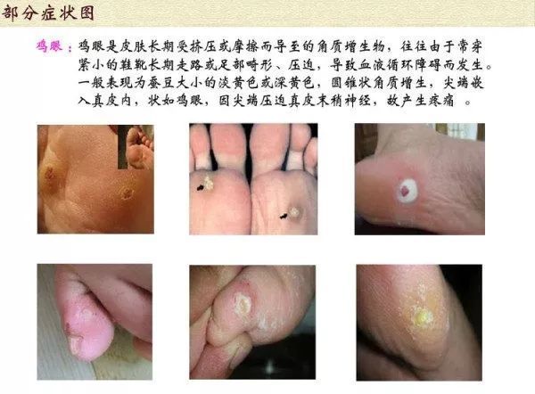 腳底板上的這些硬結,是雞眼?還是蹠疣?